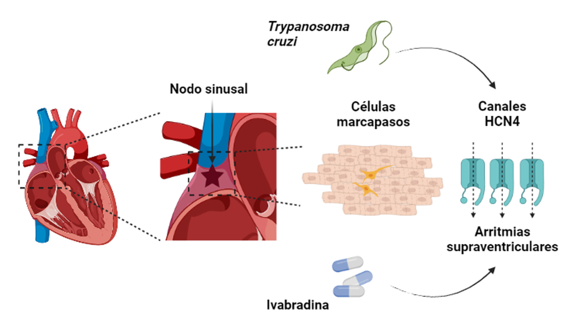 Imagen que muestra la ubicación del nodo sinusal en el corazón y la morfología de las CM en el tejido cardiaco. La infección por T. cruzi aumenta la expresión de los canales HCN4 de las CM. En estas condiciones el tratamiento con Ivabradina puede dar lugar a la aparición de arritmias supraventriculares.