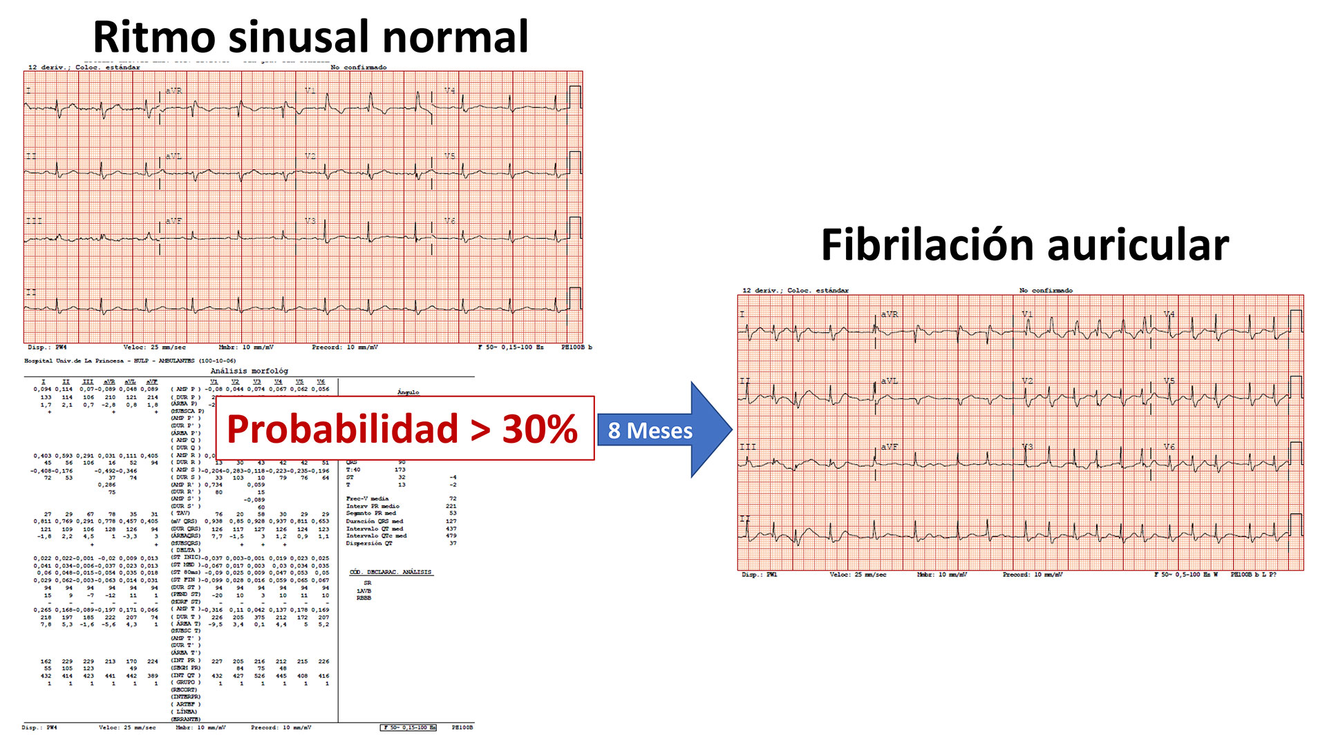 Imágenes de dos electrocardiogramas mostrando un ritmo sinusal normal y otro a los 8 meses con fibrilación auricular