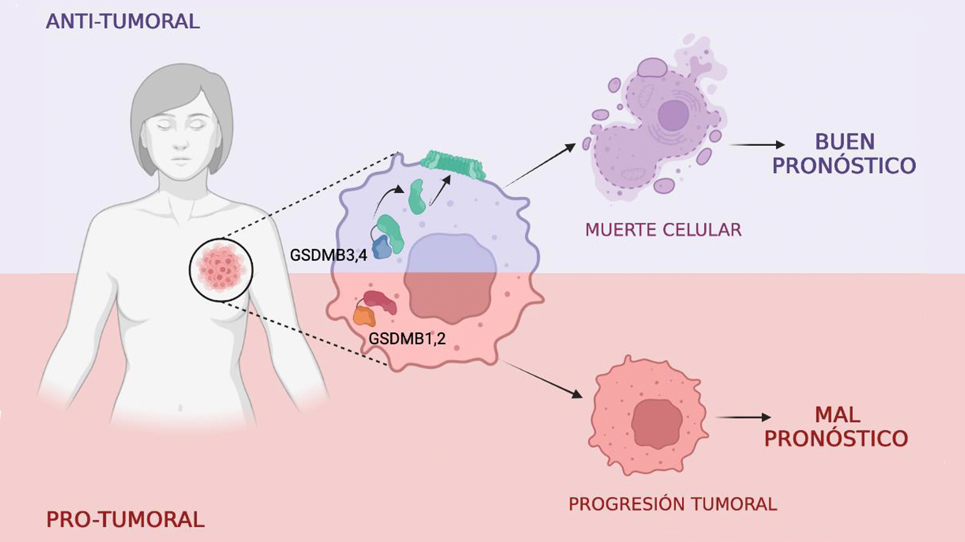 Diagrama que muestra la implicación clínica de las diferentes isoformas de GSDMB en cáncer de mama HER2