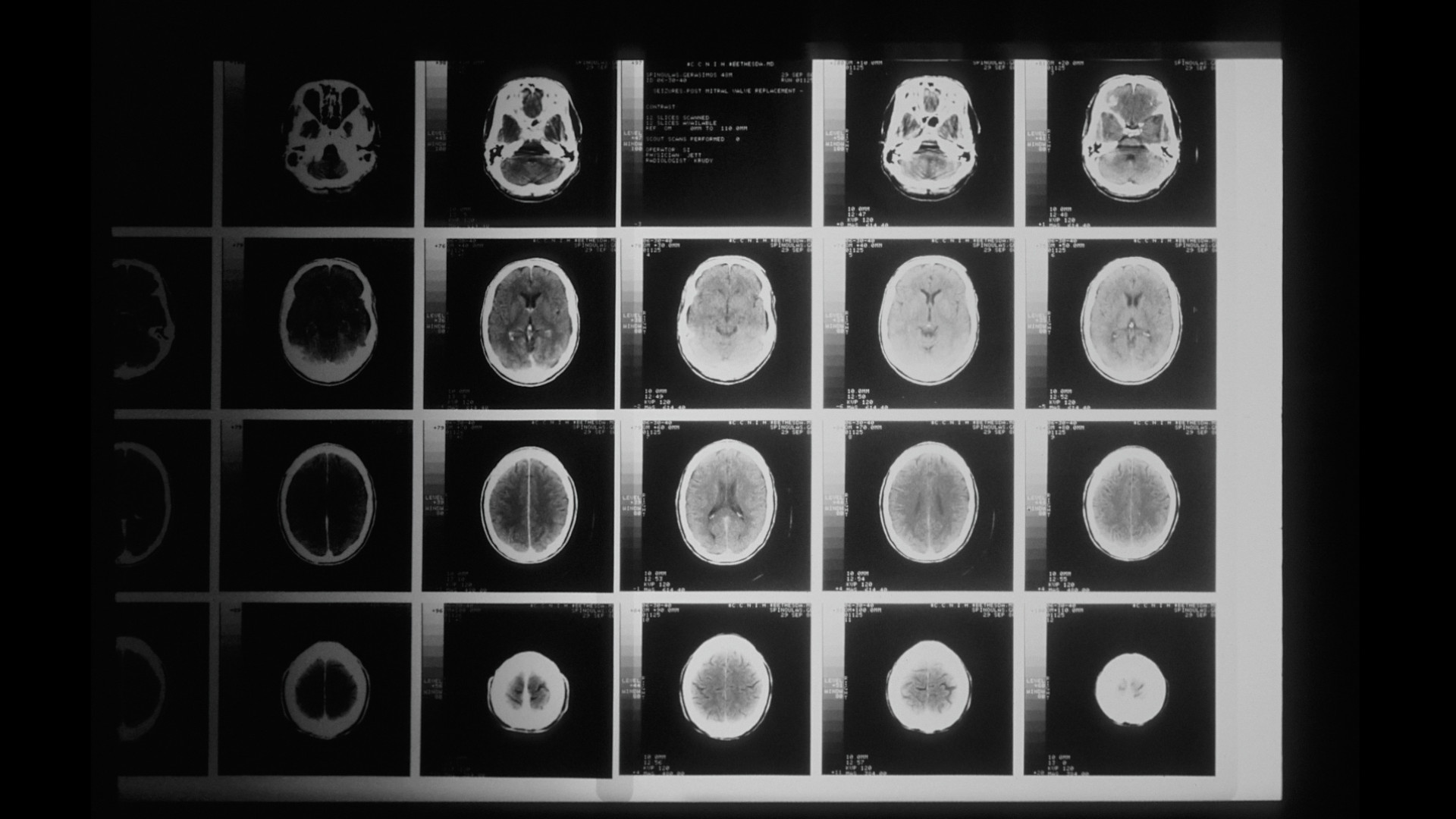 Imagen de una imagen radiográfica con varias secciones del cerebro.