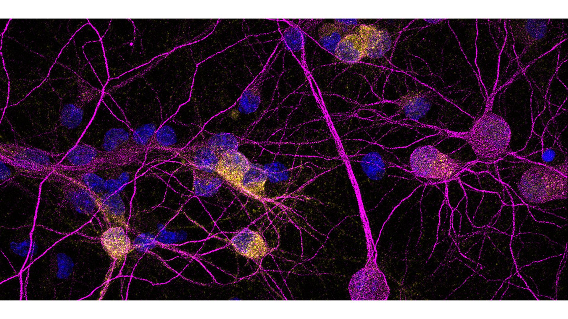 Inmunofluorescencia de neuronas de estriado en cultivo; la proteína PKD1 en amarillo. / Ana Simón (IIBM-CSIC-UAM)