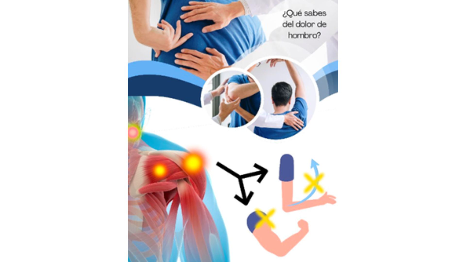 El dolor en el área del deltoides, la pérdida de movimiento y fuerza, y los puntos gatillo activos son características clínicas clave en el dolor de hombro relacionado con el manguito rotador. / UAM