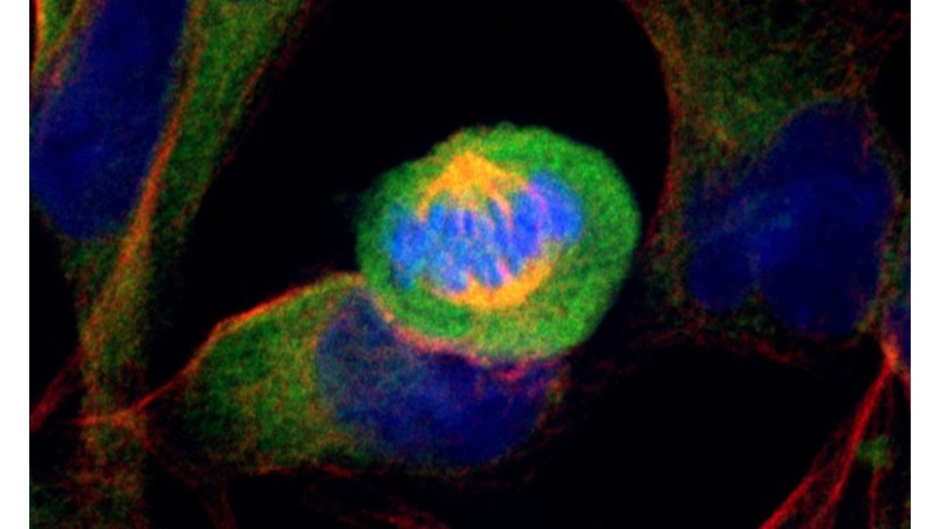 Células de cáncer de páncreas humano en división celular. El color azul indican los cromosomas en una celula en division celular siendo transportados por los microtubulos (amarillo). El citoplasma en color verde. Crédito Imagen capturada por Ander Bastida Urkiza / UC3M.